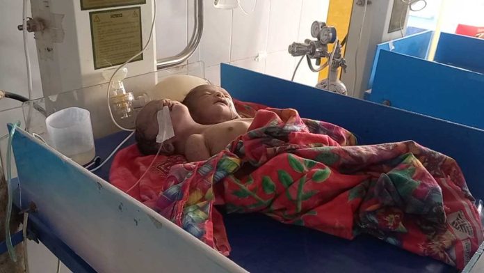 দুই মাথা নিয়ে শিশুর জন্ম, দুই ঘণ্টা পর মৃত্যু